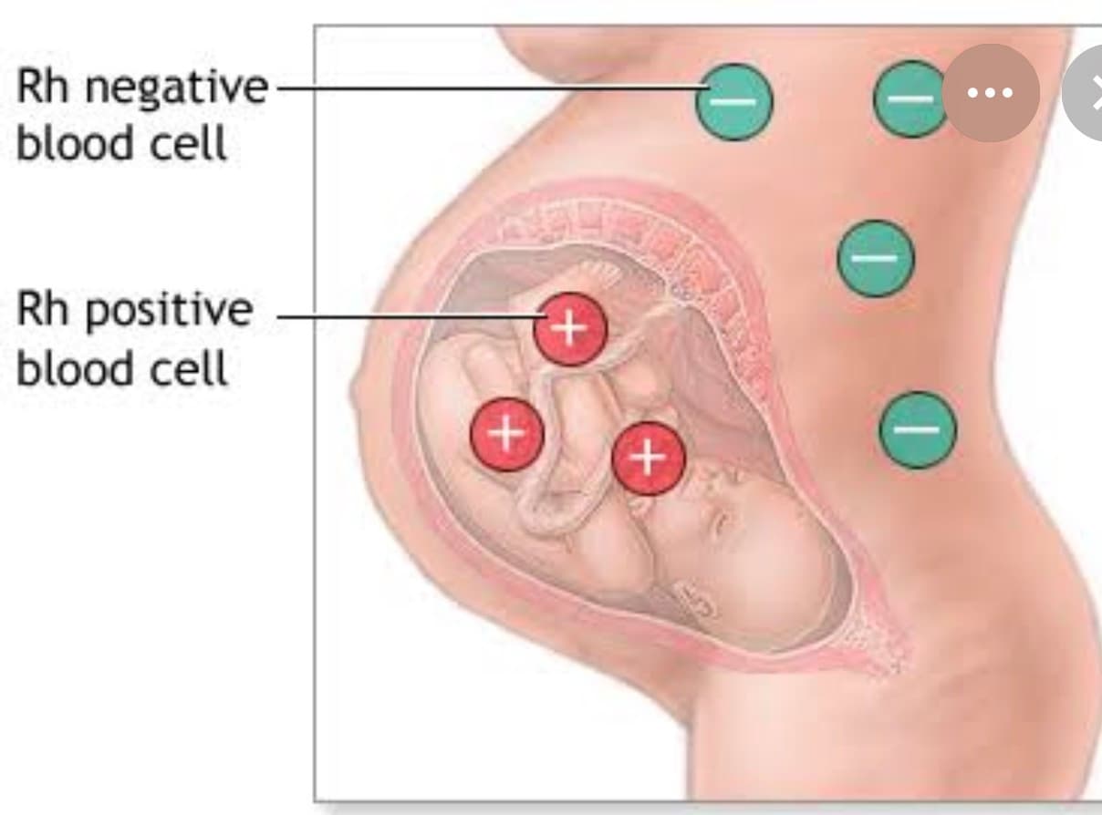 Rhesus (Rh) Factor and Pregnancy