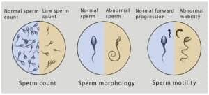 How Does Sperm Quality Impact IVF?