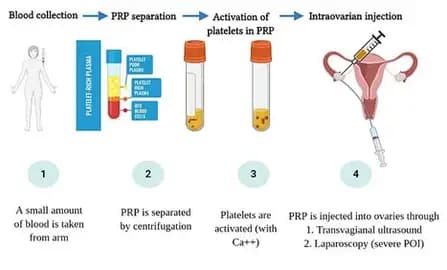 PRP OVARIAN & ENDOMETRIAL REJUVENATION