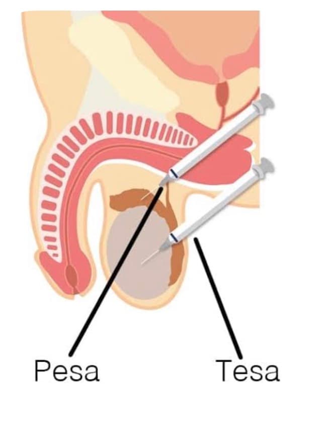 Surgical Sperm Retrieval 