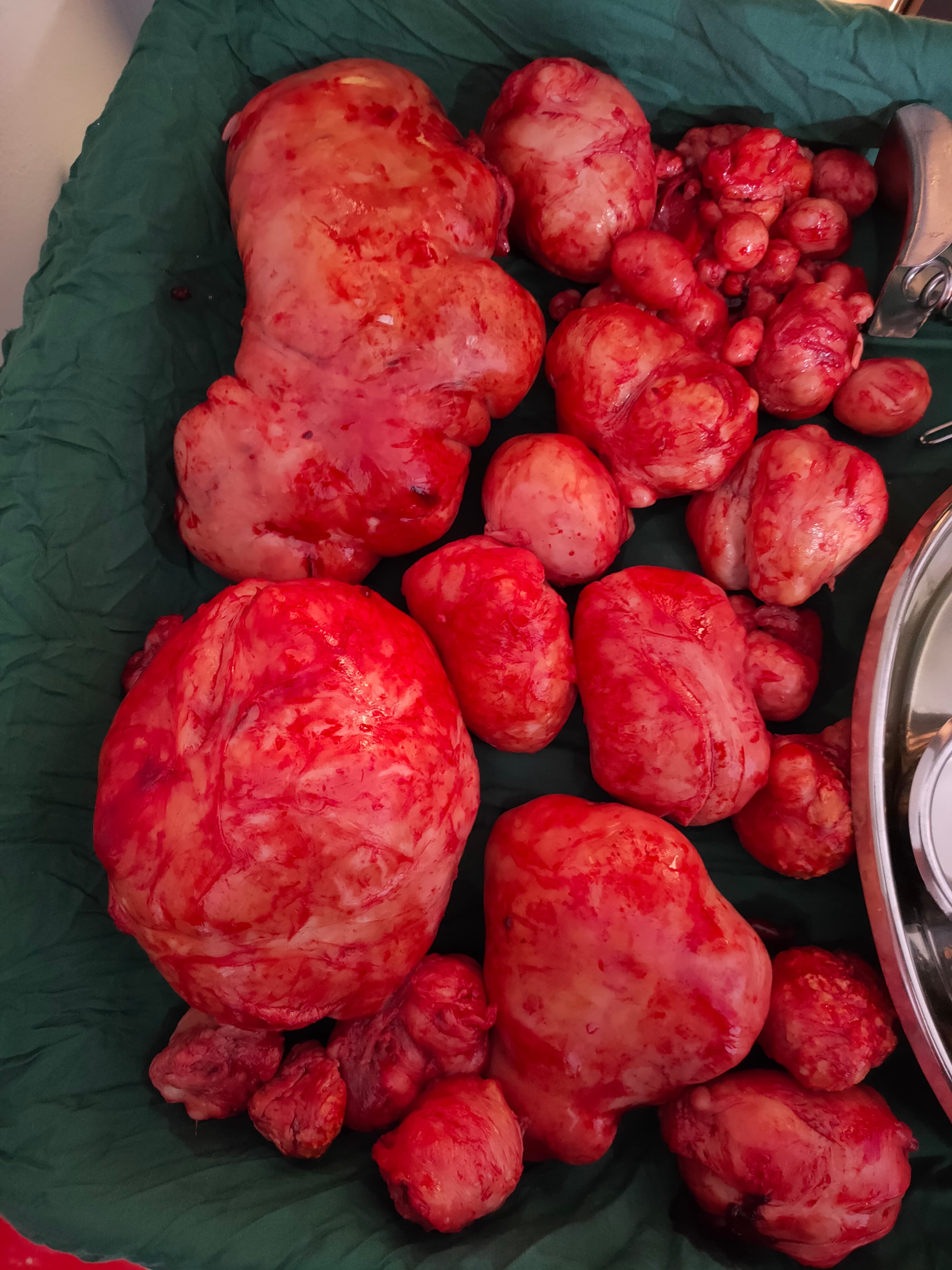 Fibroids: Do you need a Myomectomy?
