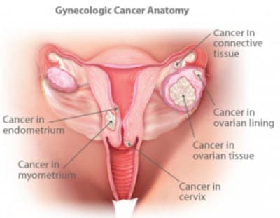 GYNECOLOGICAL CANCER SCREENING