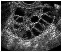 Understanding Polycystic Ovary Syndrome (PCOS)
