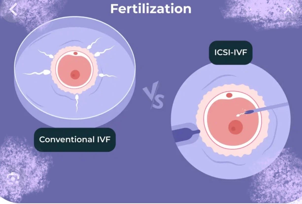 Conventional IVF Vs IVF +ICSI